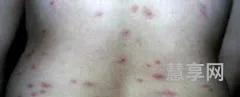季节性荨麻疹(胆碱性荨麻疹是怎么引起的)