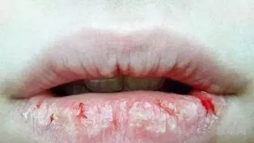 嘴唇越舔越干裂是因为什么(嘴唇舔的干裂怎么办)