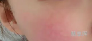 为什么脸上会有红血丝(修复红血丝最好的方法)