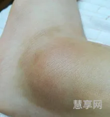 脚扭了怎么办(脚扭伤后如何快速恢复)