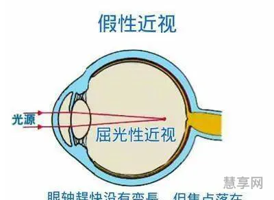 眼与书本距离为多少厘米(远视储备值对照表)