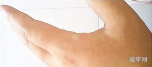 夏天手上长小水泡(出了水泡怎么处理)