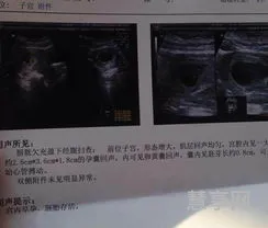 b超如何看胎儿性别(b超单有这个一般是男孩)