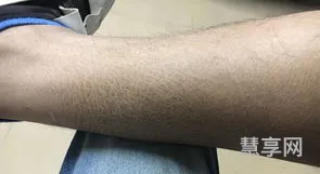 小腿皮肤粗糙(脸摸起来磨砂感小颗粒不痛不痒)