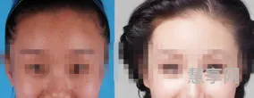 脸部肤色不均(嘴巴周围黑色素怎么去除)