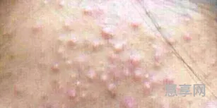 去黑头粉刺妙招(脸上很多黑头粉刺怎么去除)