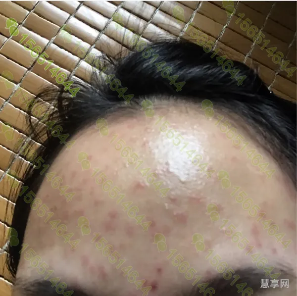 额头长痘痘是什么原因怎么调理(面部长痘痘的位置图解)