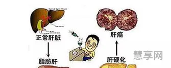 肝硬化应该注意什么(肝开始硬化还能活多久)