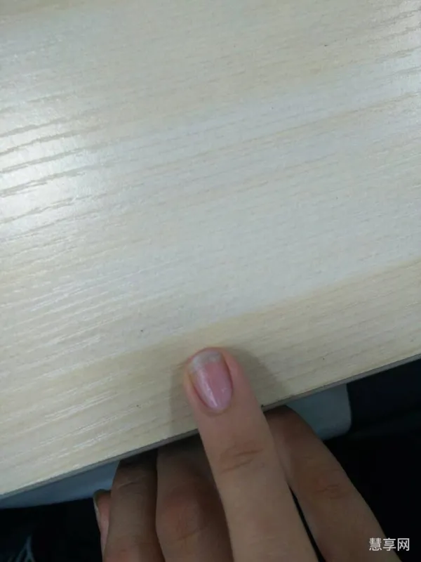 指甲上有凹陷小坑是怎么回事(指甲表面有许多小坑)