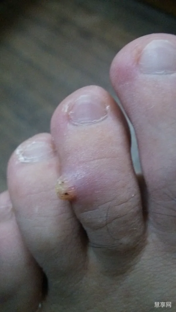 鱼痣的去除方法有哪些(怎样去掉手上的鱼痣)